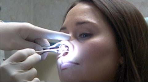 Procedimiento nasal